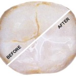 World-Pediatric-Dental-Before-After-Sealant