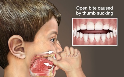 Thumb Sucking and Pacifier Use